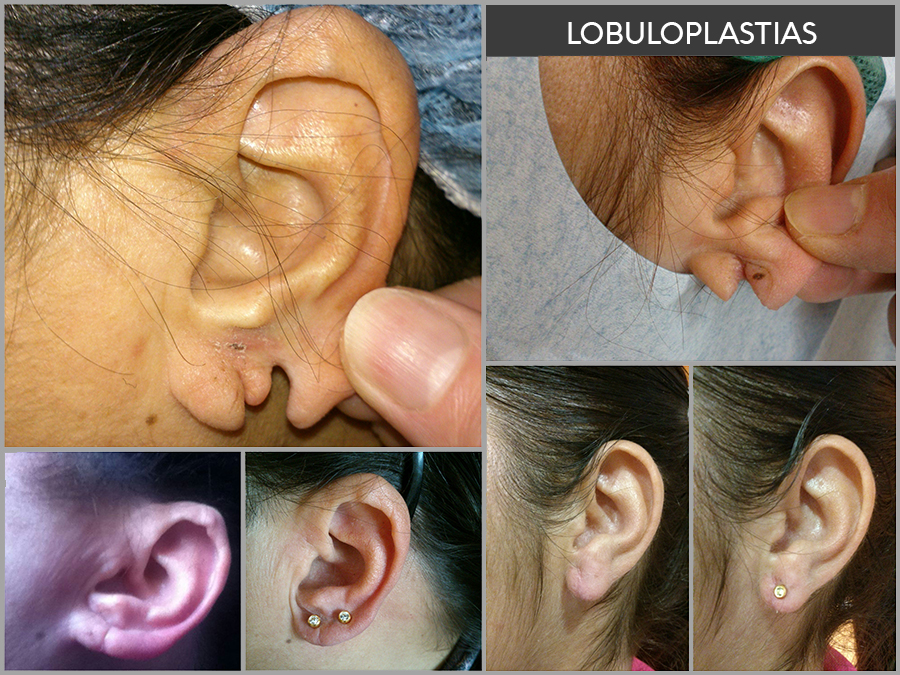 orejas rasgadas (lobuloplastia) malaga